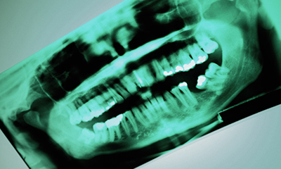 La radioactivité chez le dentiste