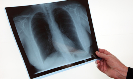 L’exposition aux rayons X en radiologie